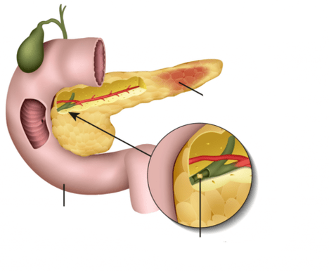 a pancreatite é unha inflamación do páncreas